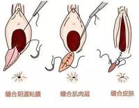 独家揭秘：最新侧切手术图文并茂，谨慎点击观看